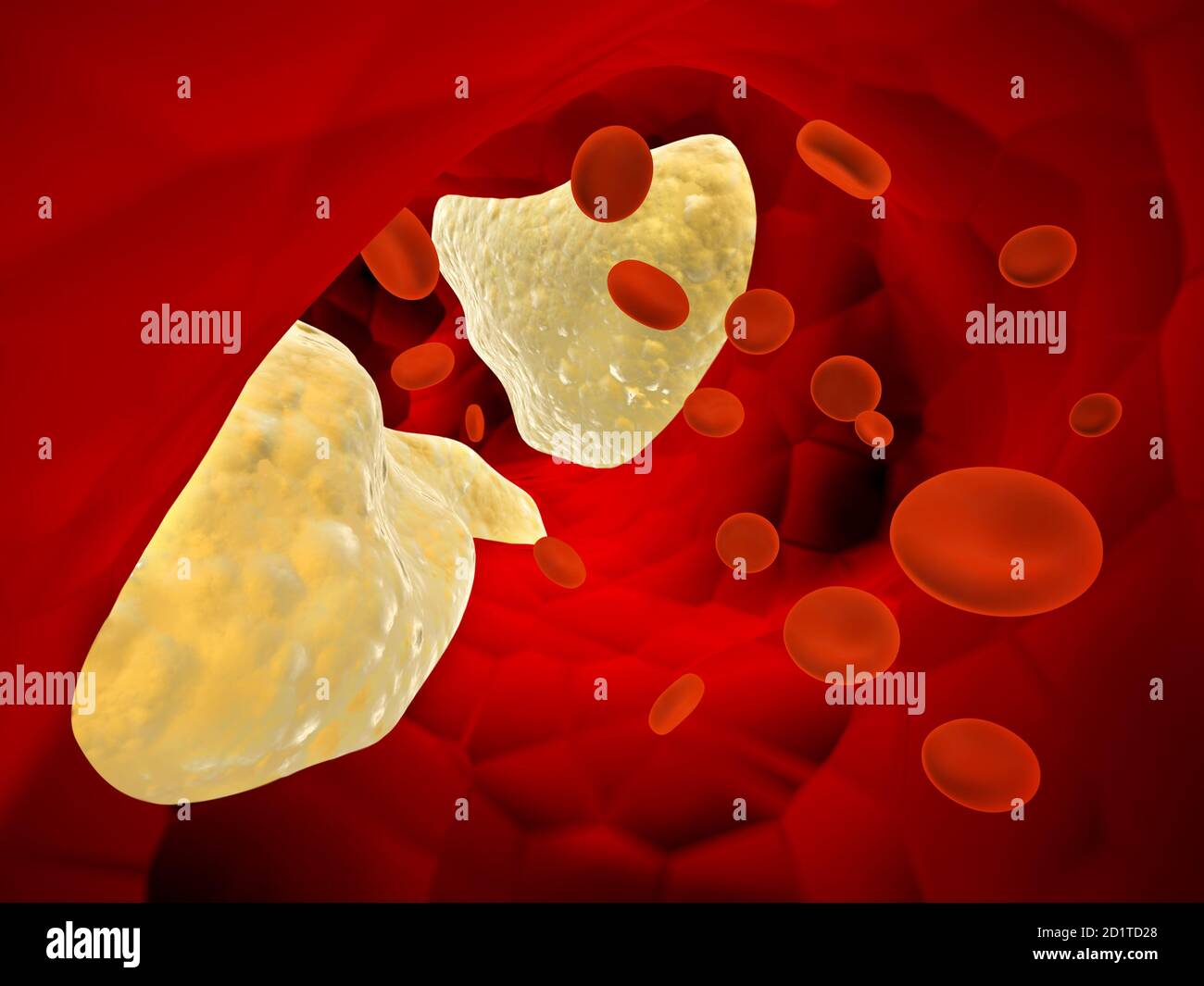 Cholesterol plaque in artery (atherosclerosis) and erythrocytes. Clogged Artery. 3d render Stock Photo