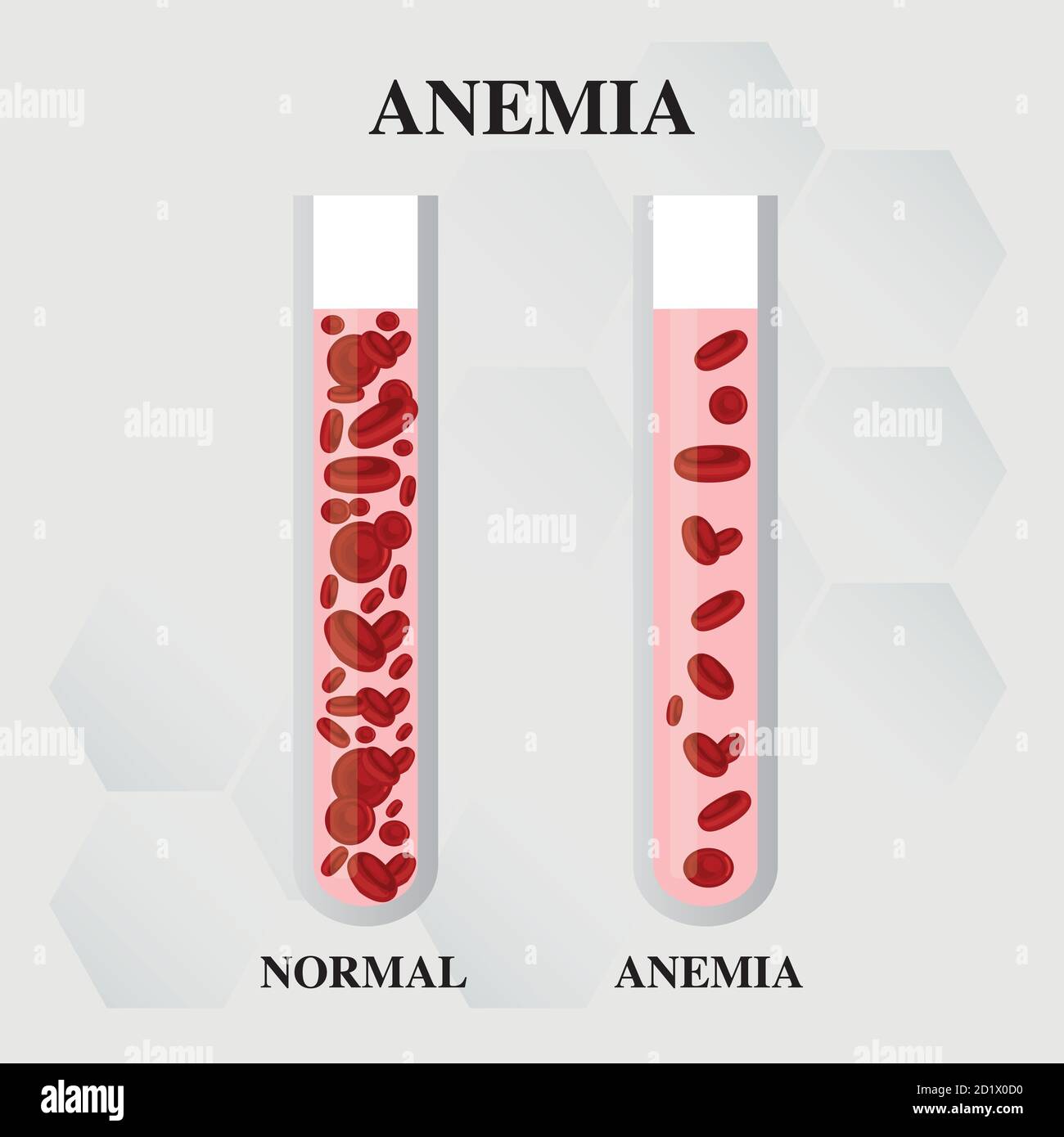 Anemia amount of red blood Iron deficiency anemia difference of Anemia