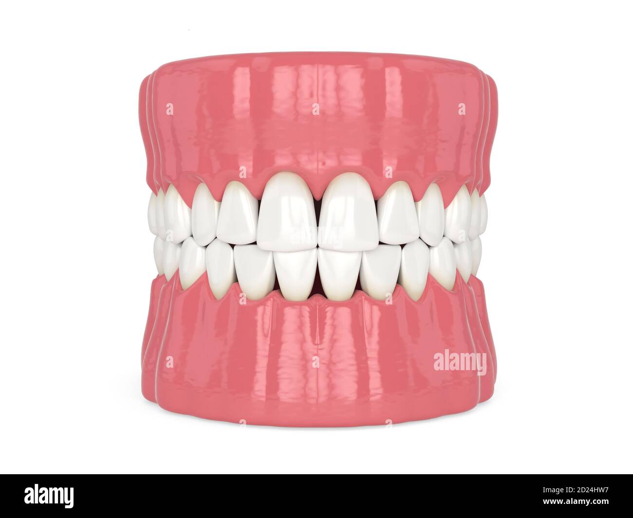 3d render of human jaw with black triangles between teeth isolated over ...