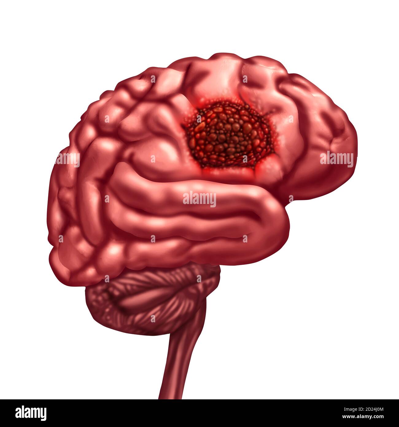 Brain cancer anatomy concept and malignant tumor symbol as a neurology body part with a microscopic magnification of malignant cells dividing. Stock Photo