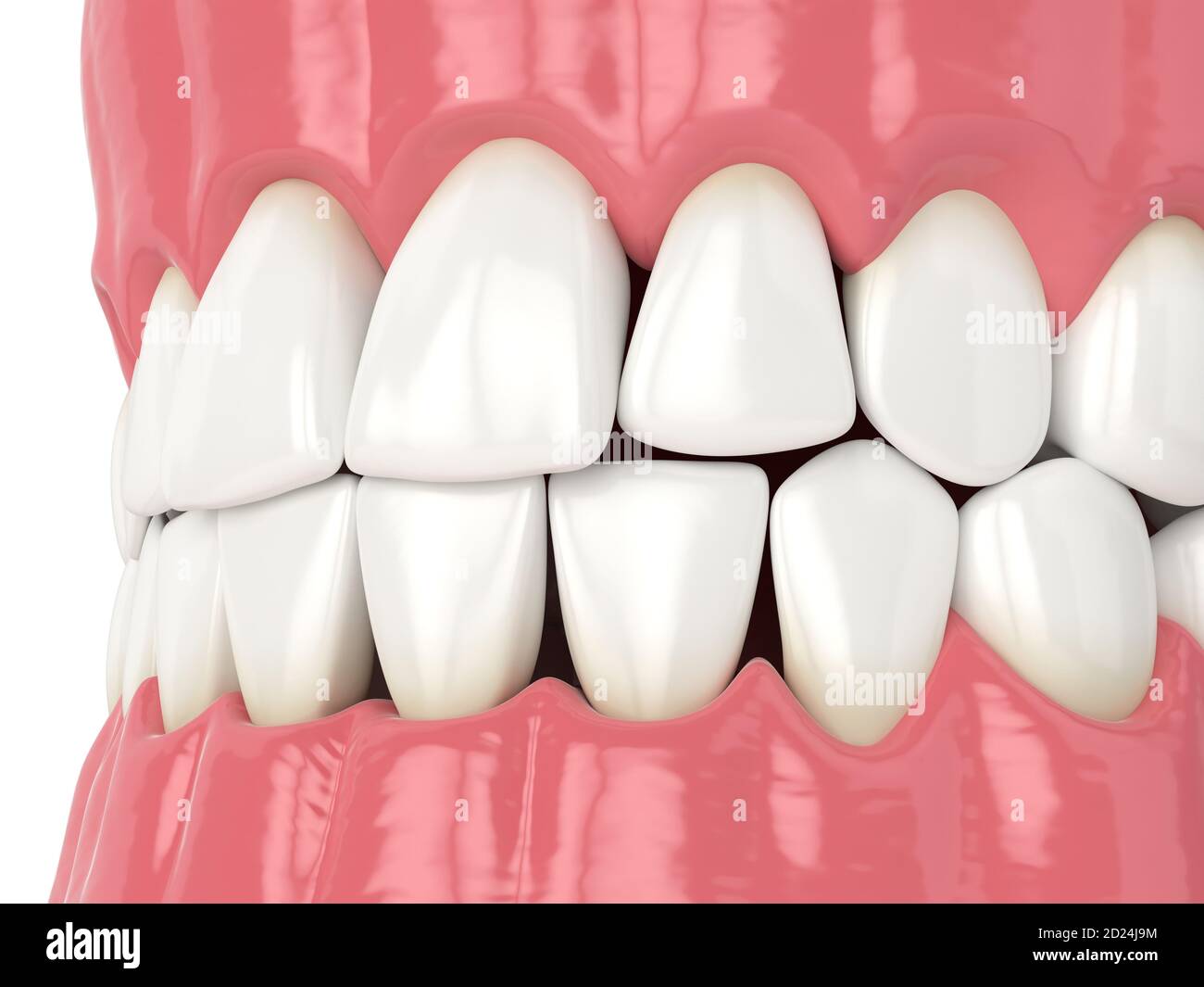 3d render of human jaw with black triangles between teeth Stock Photo