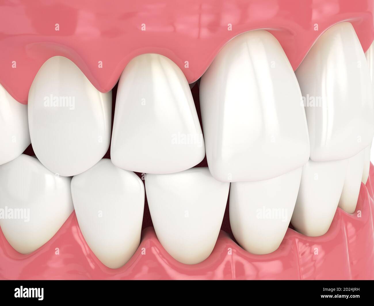 3d render of human jaw with black triangles between teeth Stock Photo Alamy