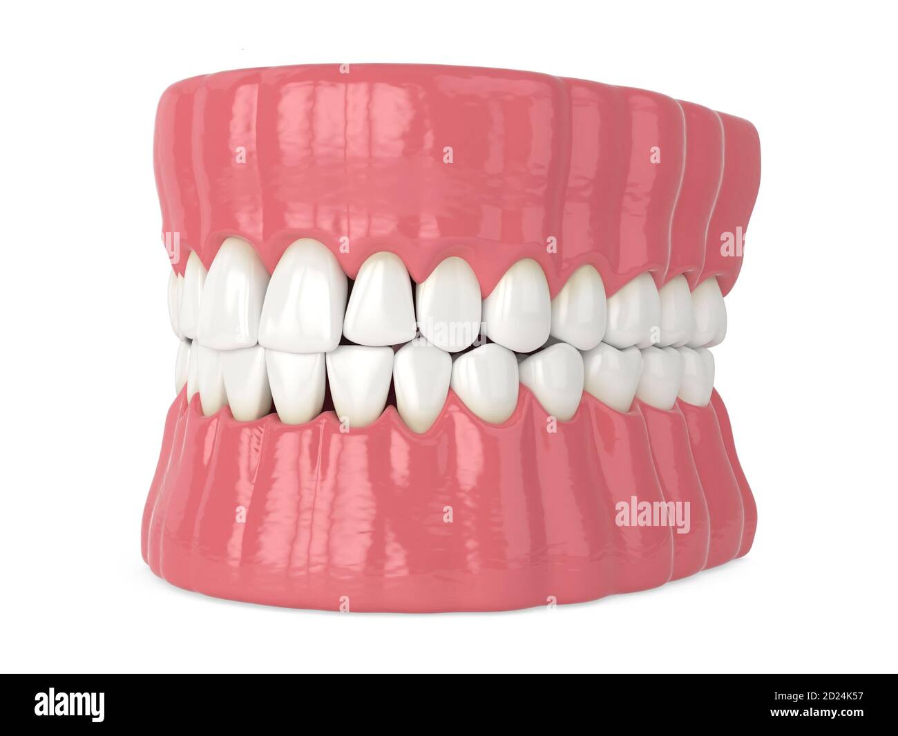 3d render of human jaw with black triangles between teeth isolated over white background Stock