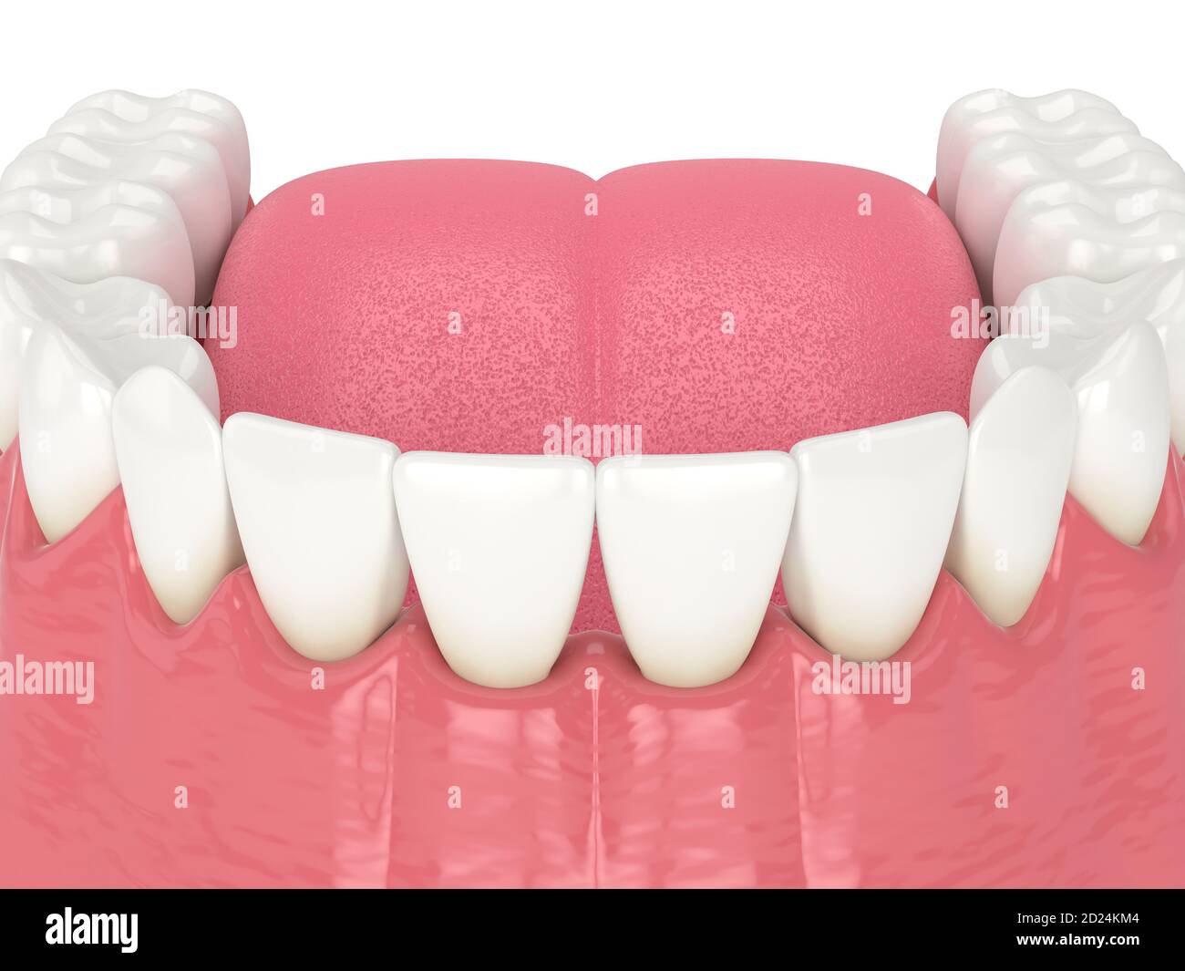 3d render of human lower jaw with black triangles between teeth Stock