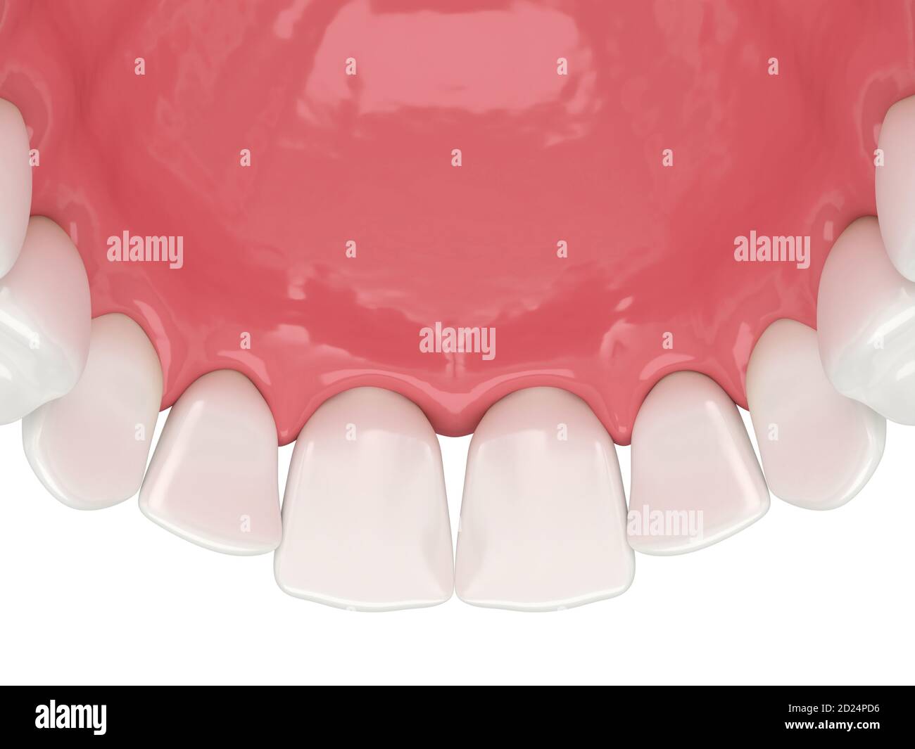 3d render of human upper jaw with black triangles between teeth Stock Photo Alamy