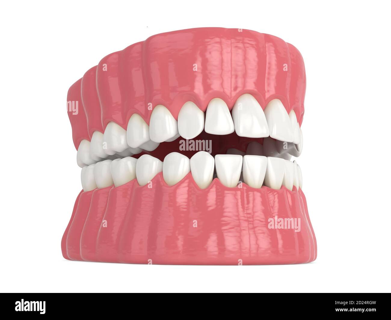 3d render of human jaw with black triangles between teeth isolated over ...