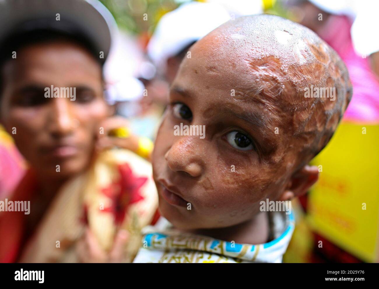 Acid Attack Survivors High Resolution Stock Photography And Images Alamy