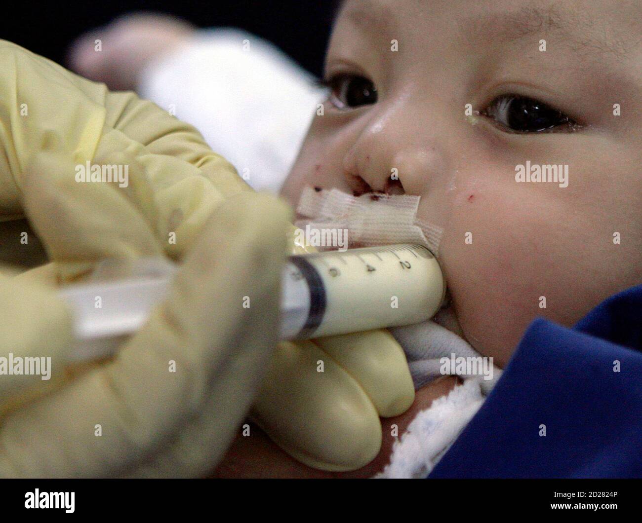 A baby boy, inflicted with a cleft lip, tries to drink his milk from a syringe after his surgery during 'Operation Restore Hope' at Diosdado Macapagal Memorial Medical Center in Caloocan City, Metro Manila April 12, 2010. Operation Restore Hope, a group of medical volunteers from Germany, New Zealand and Australia who perform surgeries for underprivileged children every year, aim to provide free surgery for about 70-80 children inflicted with cleft lips, cleft palates, and other facial deformities over a period of five days. REUTERS/Cheryl Ravelo (PHILIPPINES - Tags: HEALTH SOCIETY) Stock Photo