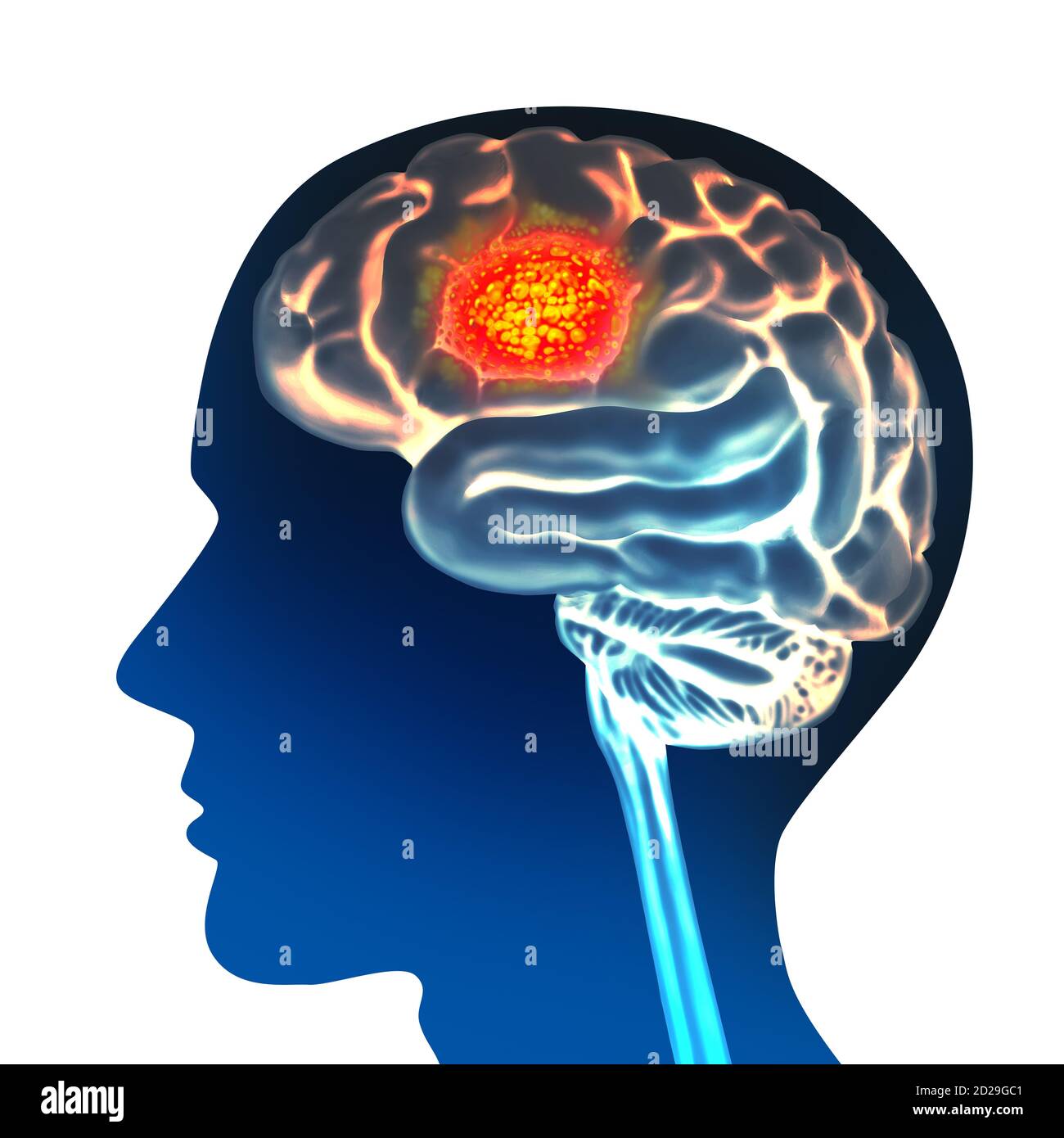 Brain cancer anatomy concept and malignant tumor symbol as a neurology body part with a microscopic magnification of malignant cells dividing. Stock Photo