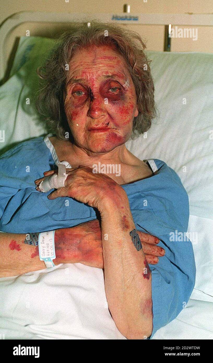 82-year-old Daisy Drew of Small Heath, Birmingham who was attacked and robbed in her home last night. Mrs Drew suffered a broken nose, finger and collar bone in the attack while the thieves escaped with her ring and less than a pound in cash. On 30.7.96 a Birmingham court heard the admission of John McDonagh and Catherine Bates that they had posed as social workers to burgle and terrorize pensioners in the area. Miss Drew was at Birmingham Crown Court on 1.10.96 for the case of the two people accused of attacking and stealing from her and two other pensioners. Stock Photo