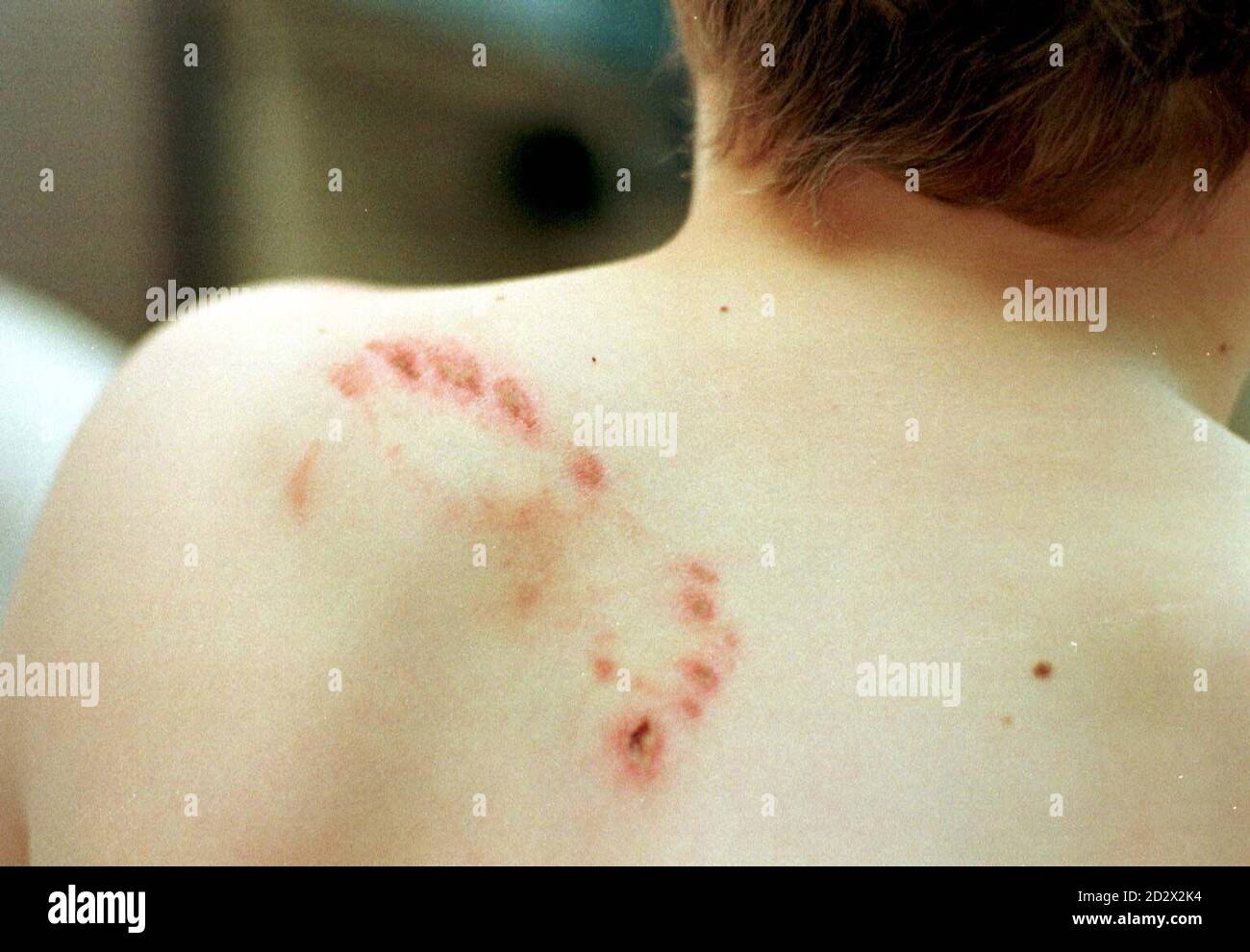 Dog bite wound hires stock photography and images Alamy