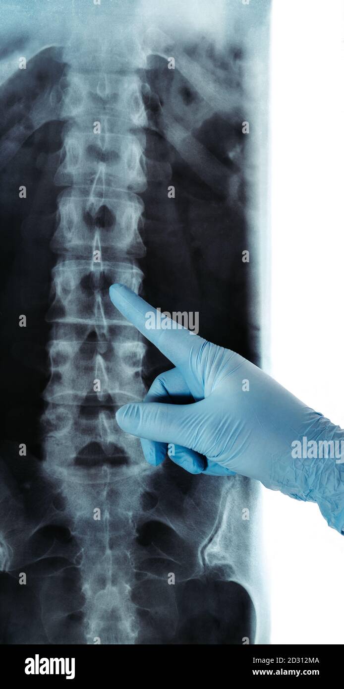 X-ray of lumbar spine radiology RTG blue glove pointed Stock Photo