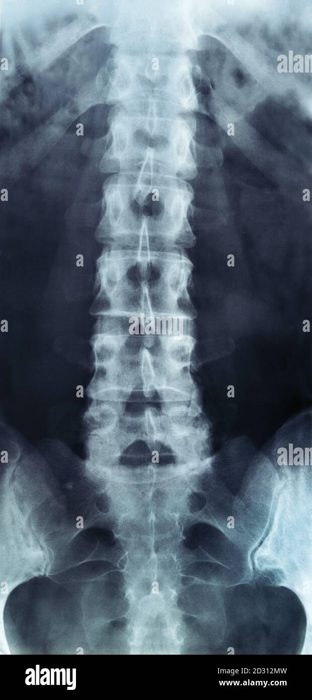 X-ray of lumbar spine, classical radiology RTG of lower back Stock Photo