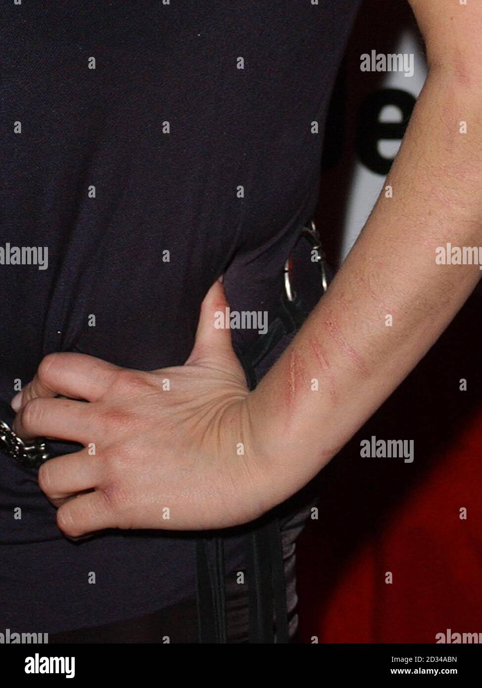 Scarred arm of Gail Porter. Stock Photo