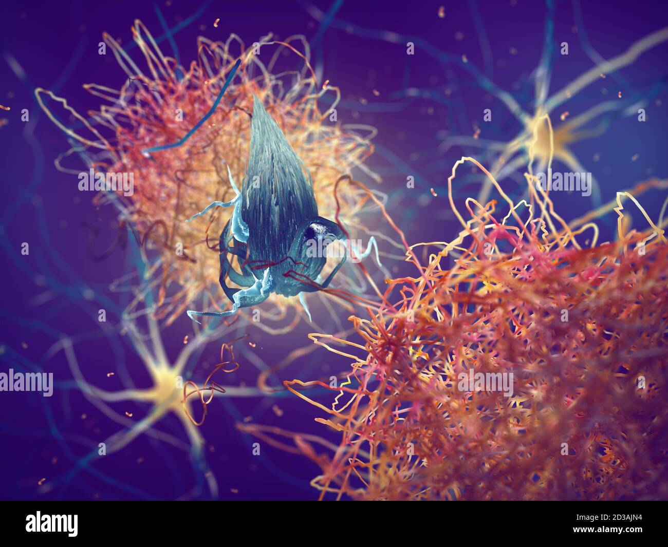 Amyloid plaques forming between neurons. Beta-amyloid protein disrupting nerve cells function in a brain with Alzheimer's disease Stock Photo