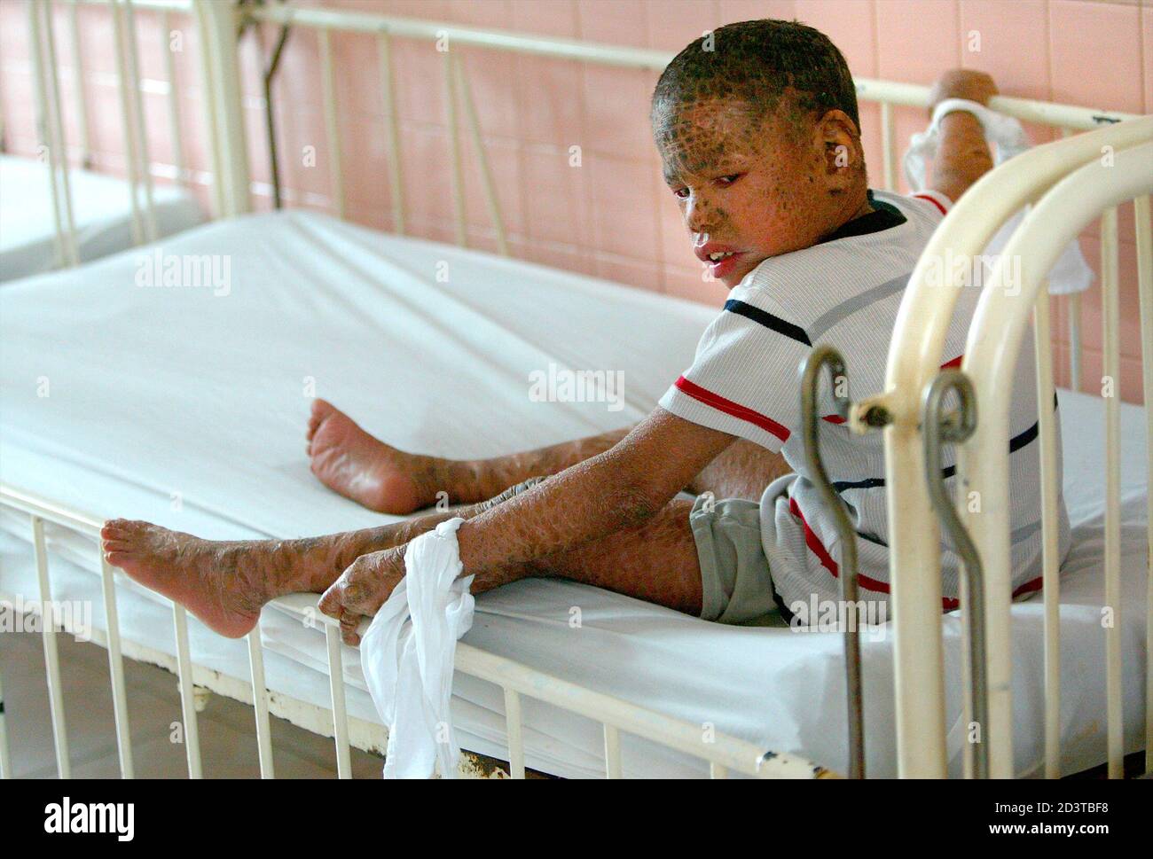 A Young Vietnamese With A Skin Disorder And Metal Retardation Sits In His Cot At The Peace Village In Tu Du Hospital In Ho Chi Minh City February 3 04 The Boy A Young Vietnamese With A Skin Disorder And Metal Retardation Sits In His Cot At The Peace Village In Tu Du Hospital In Ho Chi Minh City February 3 04 The Boy