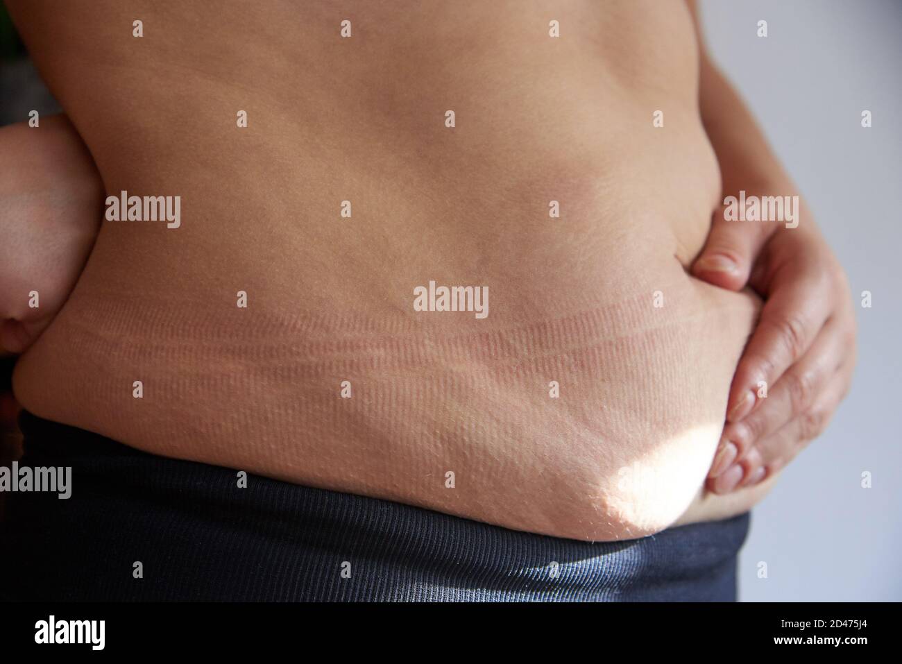 Fat and stretch marks on a woman's belly, obesity, close-up. Stock Photo