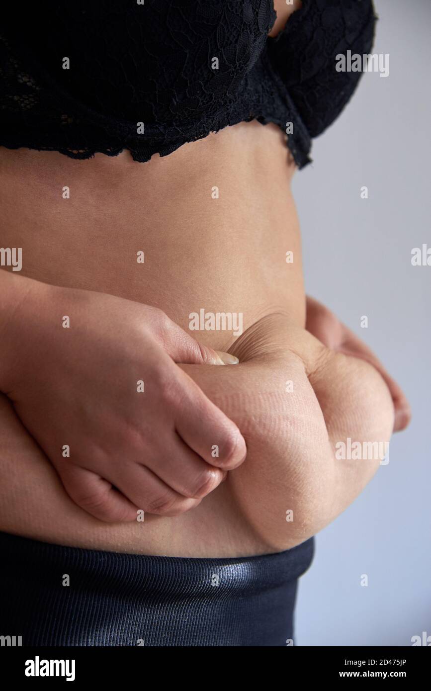 Fat and stretch marks on a woman's belly, obesity, close-up. Stock Photo