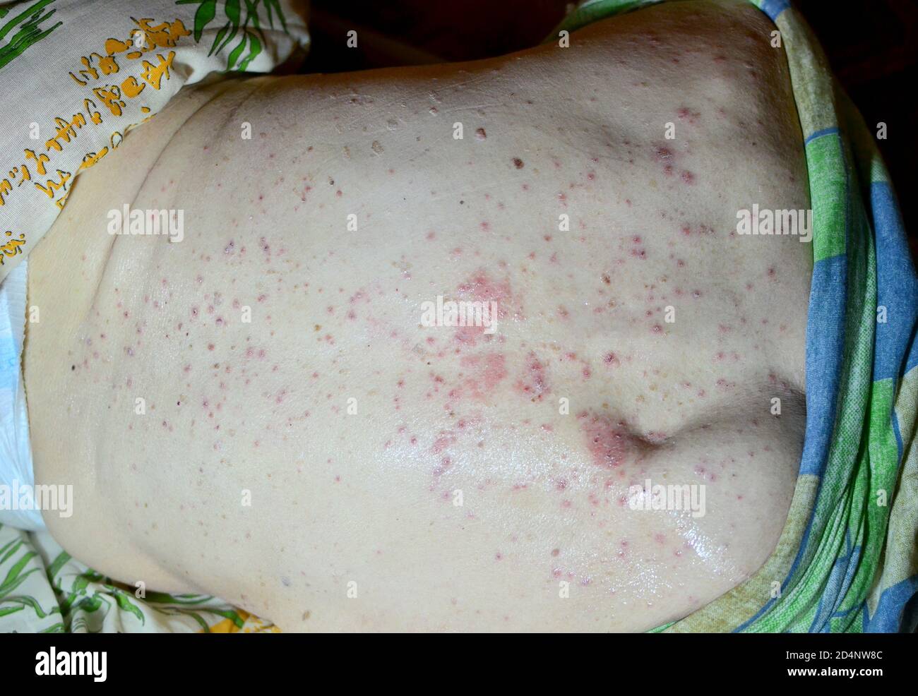 Decubitus ulcer. Pressure ulcers on skin tissue. The increased pressure