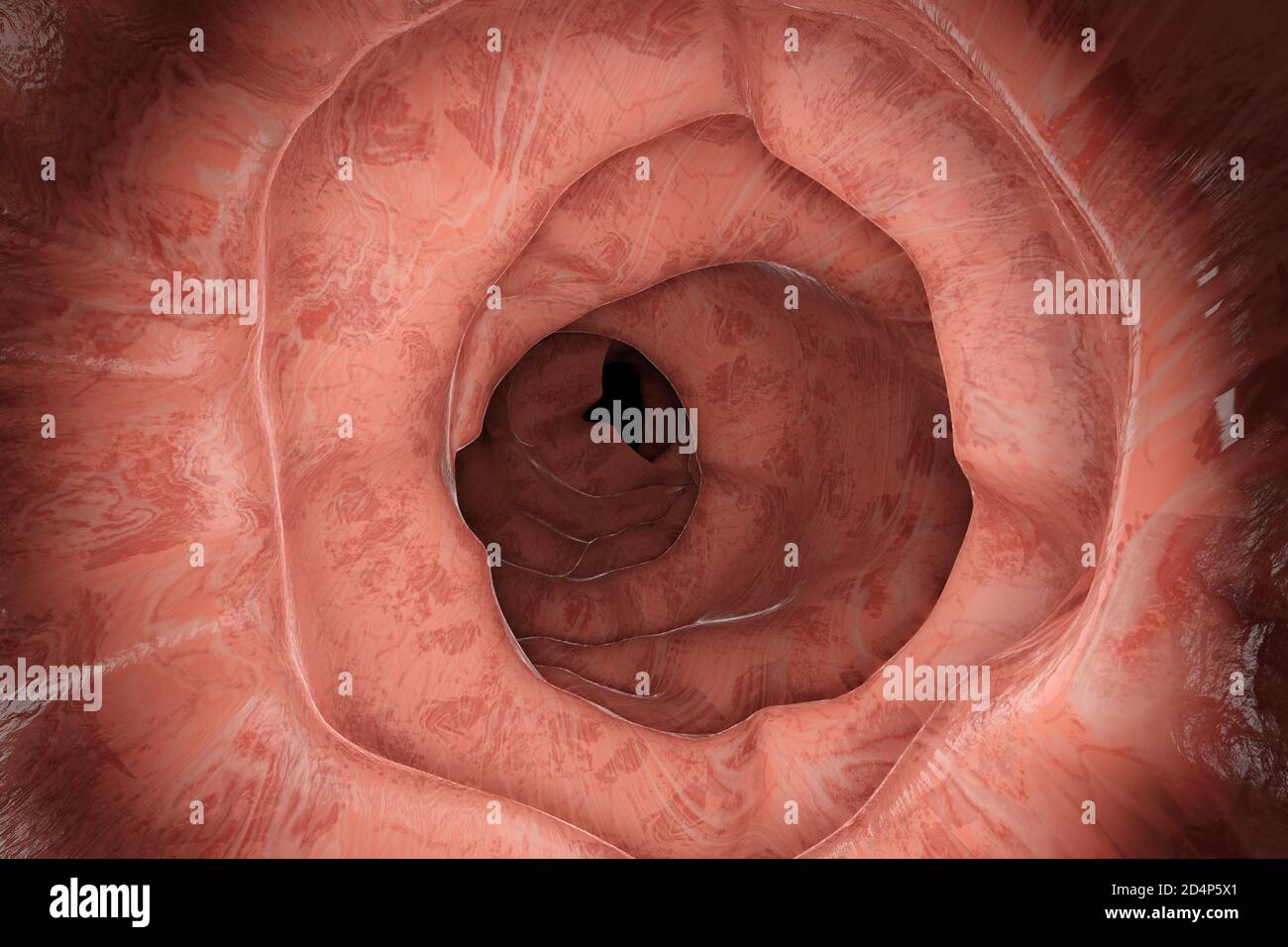 3D Illustration of a gastrointestinal polyp during Entersocopy Stock Photo