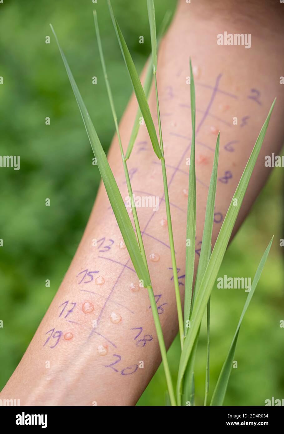 Allergy test, prick test, skin test, different ingredients are tested