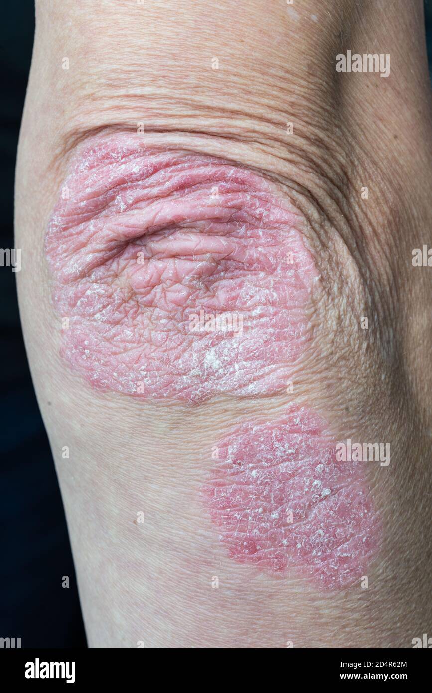 Dermatite hi-res stock photography and images - Alamy