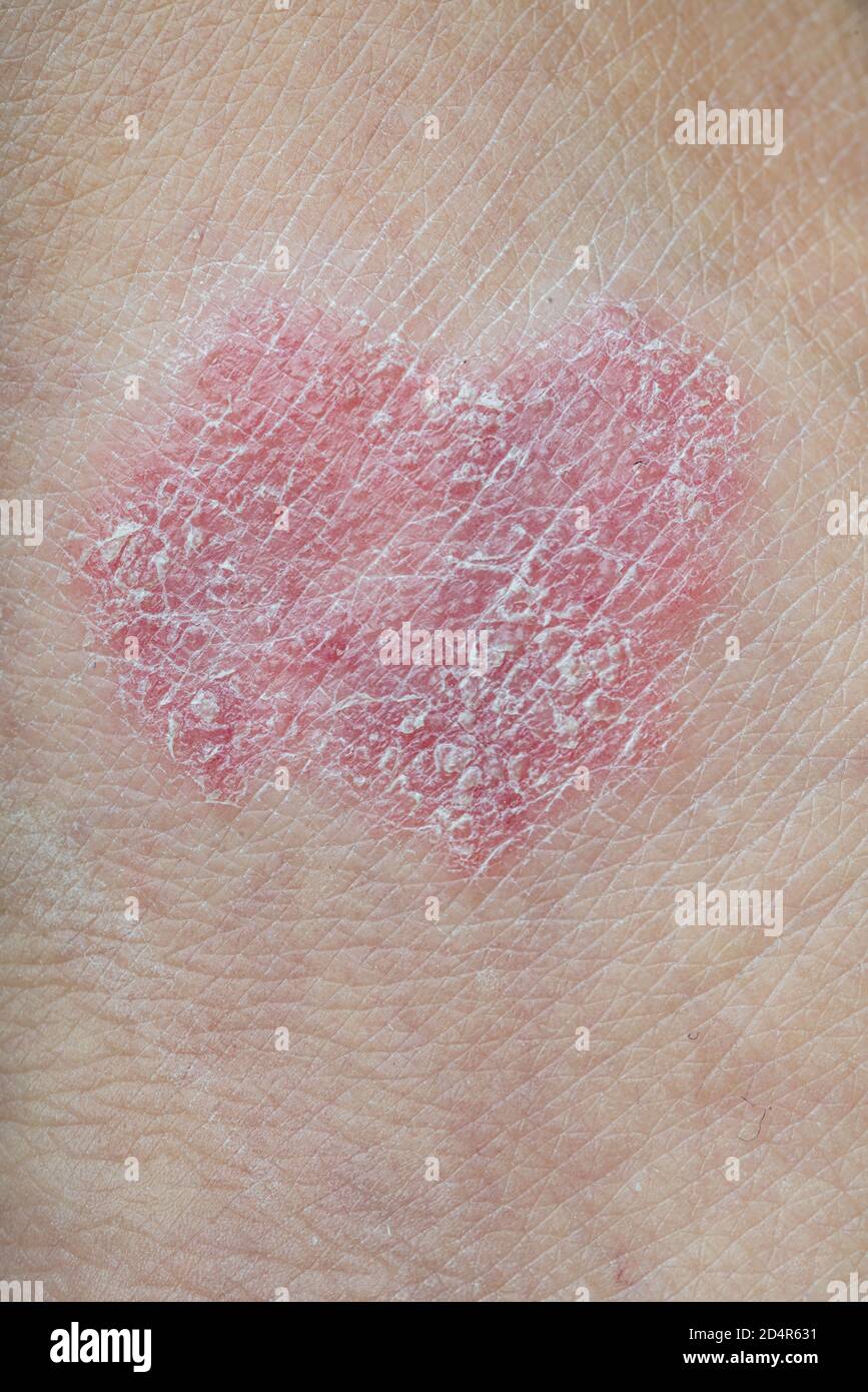 Dermatite hi-res stock photography and images - Alamy