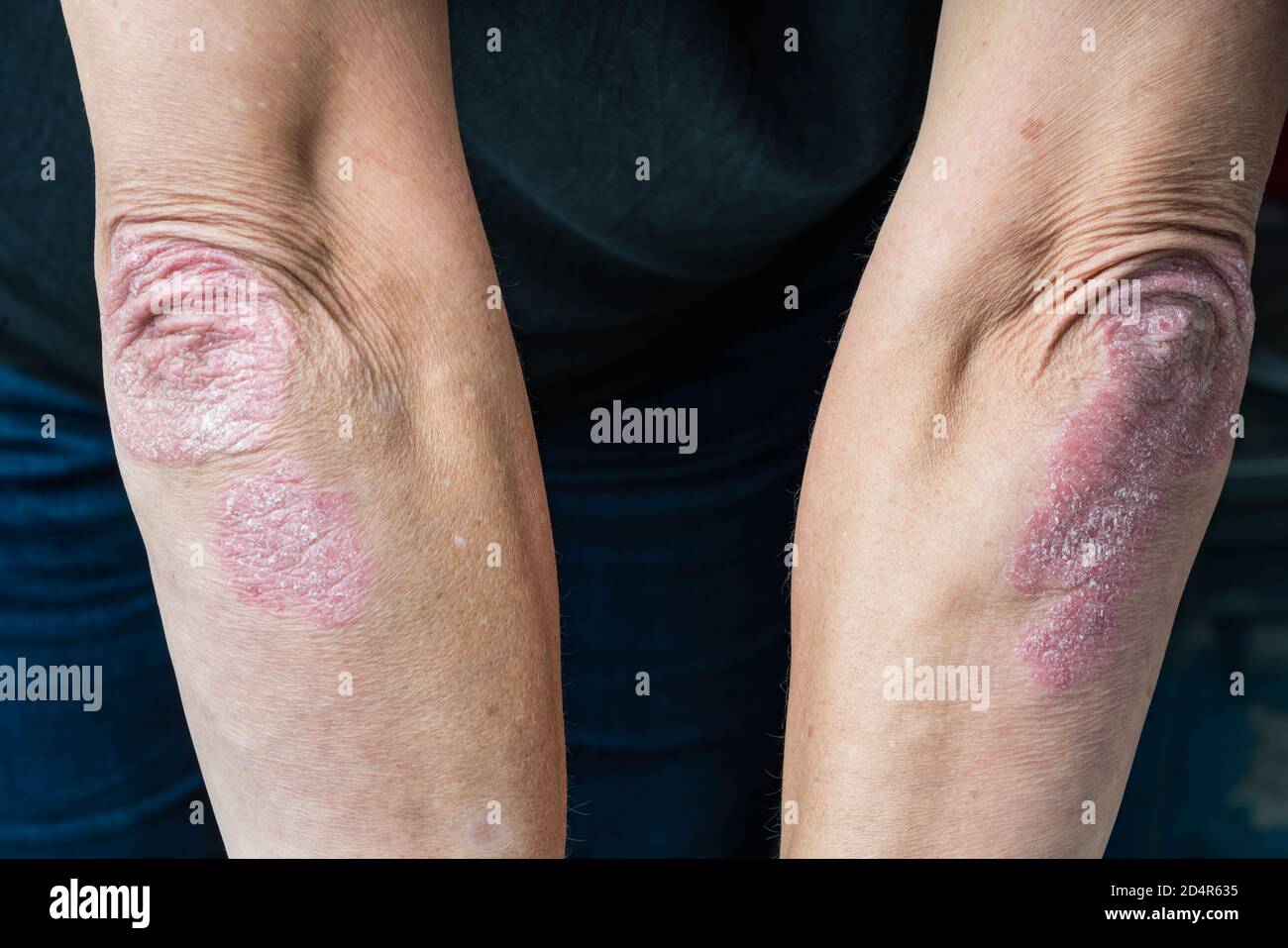 Dermatite hi-res stock photography and images - Alamy