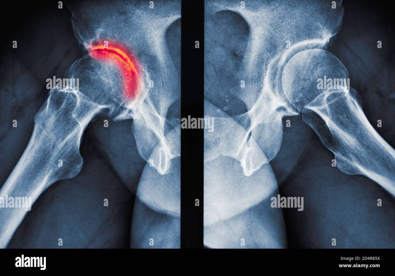 Xray showing arthritis of the hip, arthritis is a joint disease that