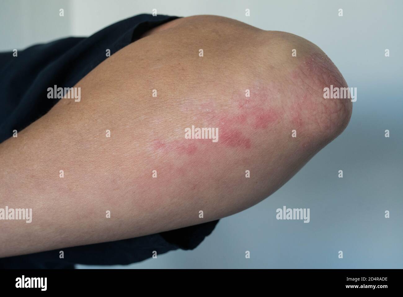 Dermatite hi-res stock photography and images - Alamy