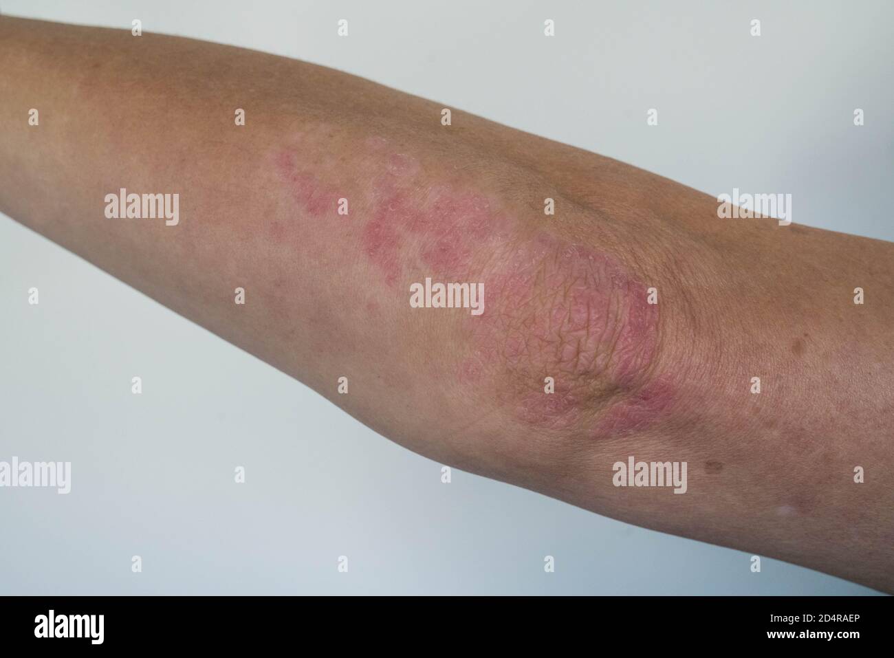 Dermatite hi-res stock photography and images - Alamy
