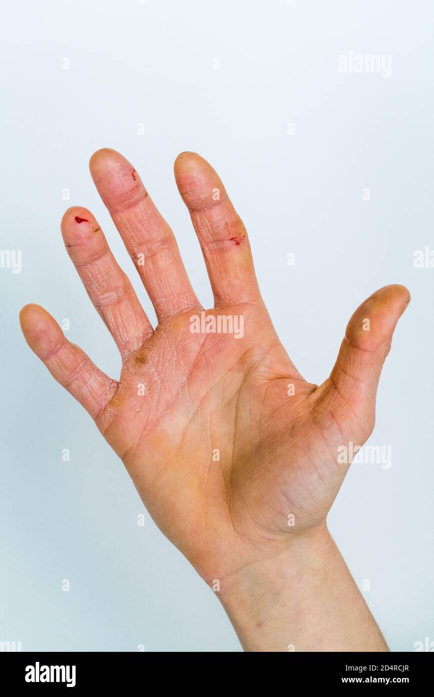 Severe eczematous rash on the hands of a woman Stock Photo Alamy