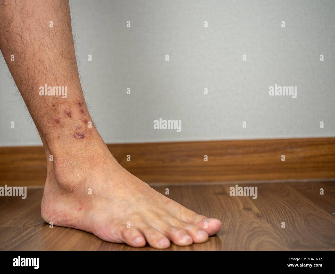 Dermatitis on feet ankle condition Stock Photo Alamy