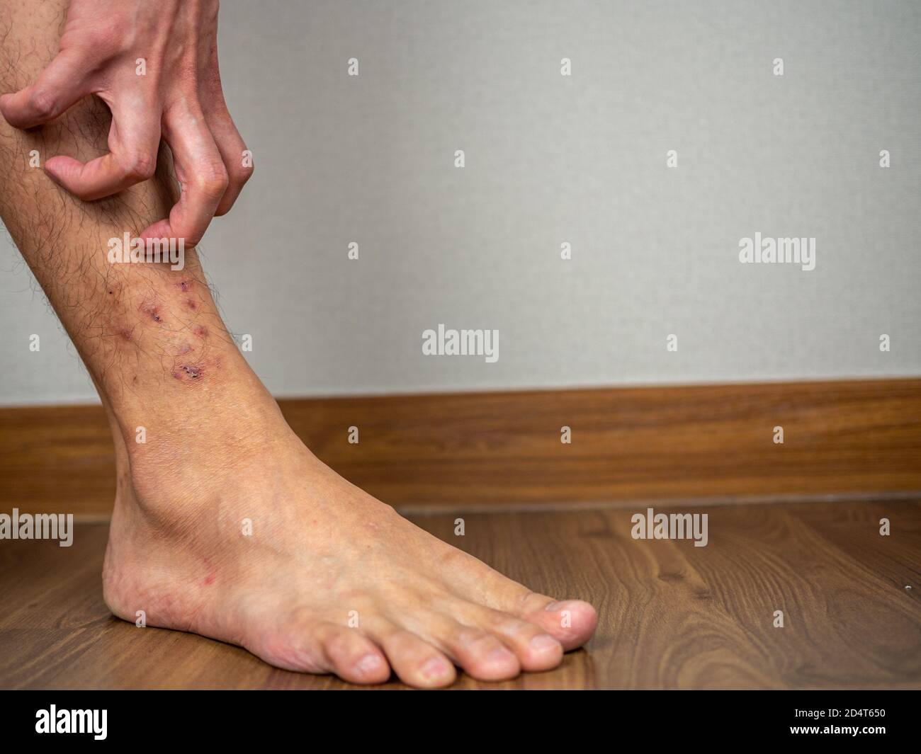 Dermatitis on feet ankle condition Stock Photo Alamy