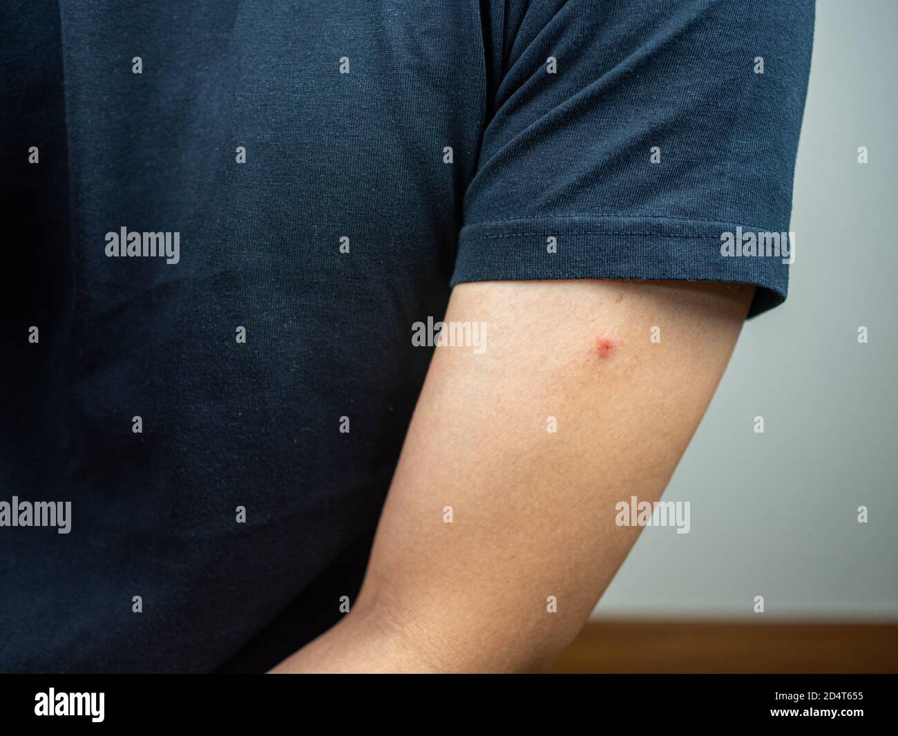 Bite scar on arm hi-res stock photography and images - Alamy