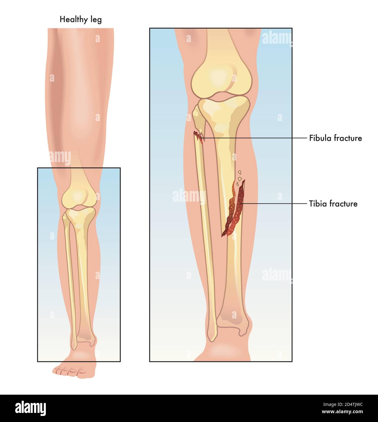 Medical illustration comparing a healthy leg to one with a fractured tibia and fibula. Stock Vector