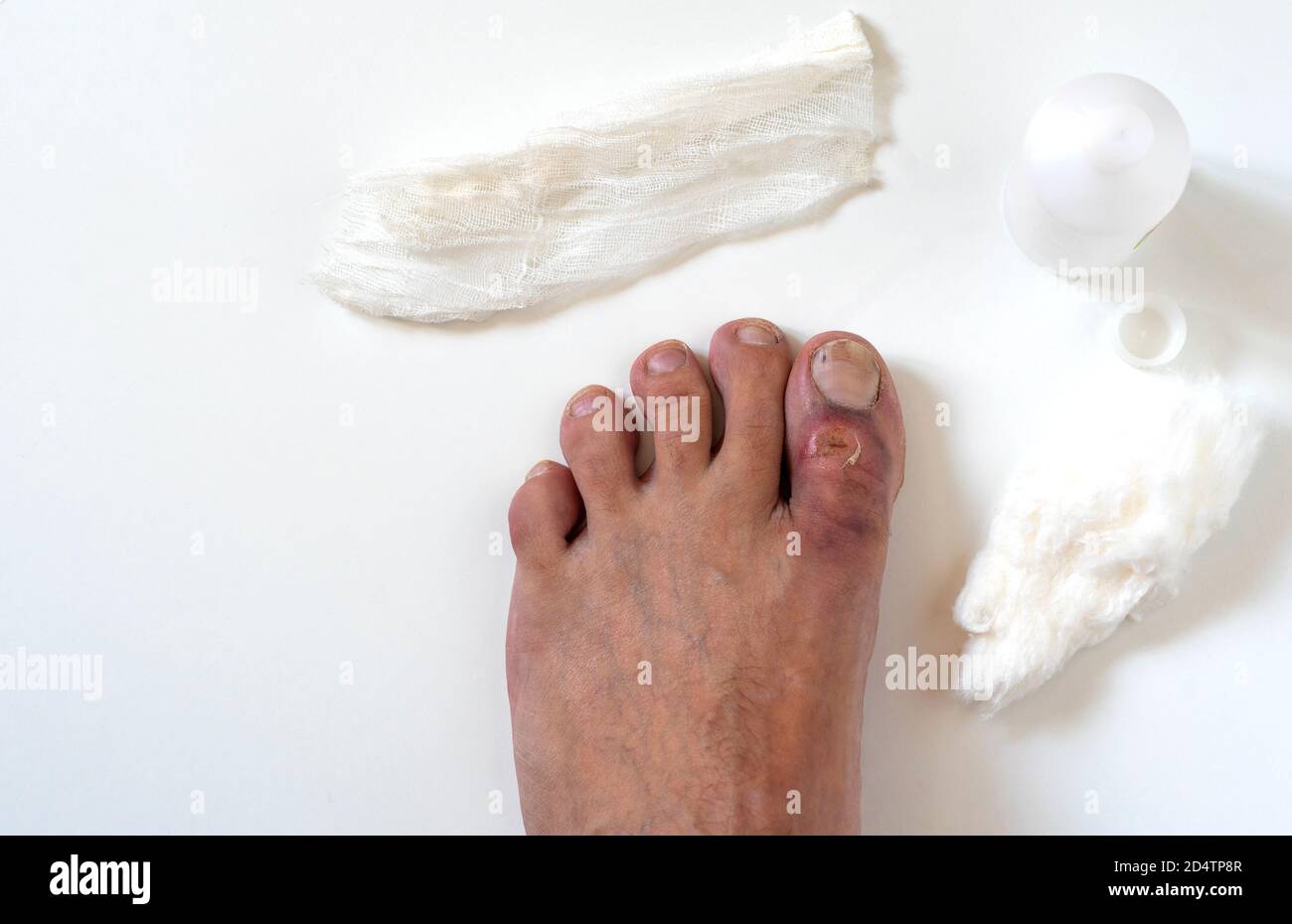 A close-up photo of a broken big toe with several cuts and bruises. The first medical aid. Top view. Isolated on white background. Stock Photo