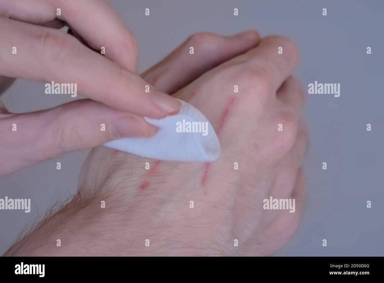 Close up view of man hand trying to treat cat scratches with cotton pad ...