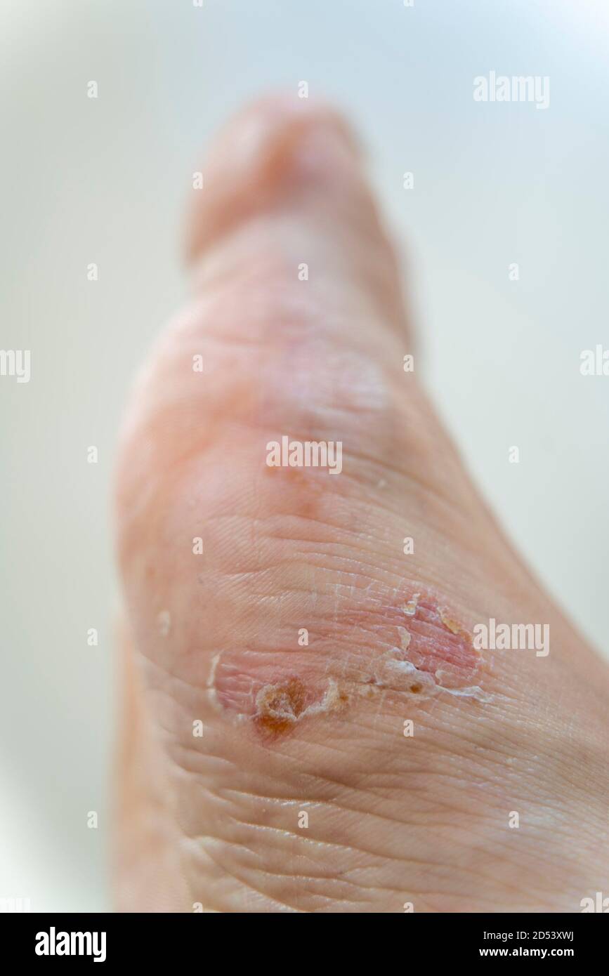 Foot with dyshidrotic eczema Stock Photo