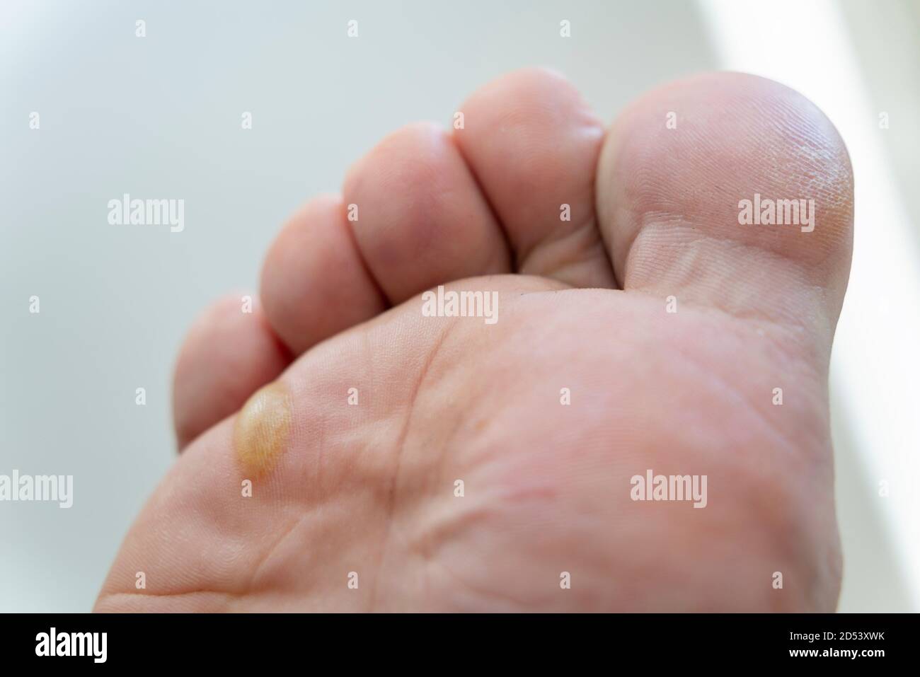 Painful sore blister on foot Stock Photo Alamy