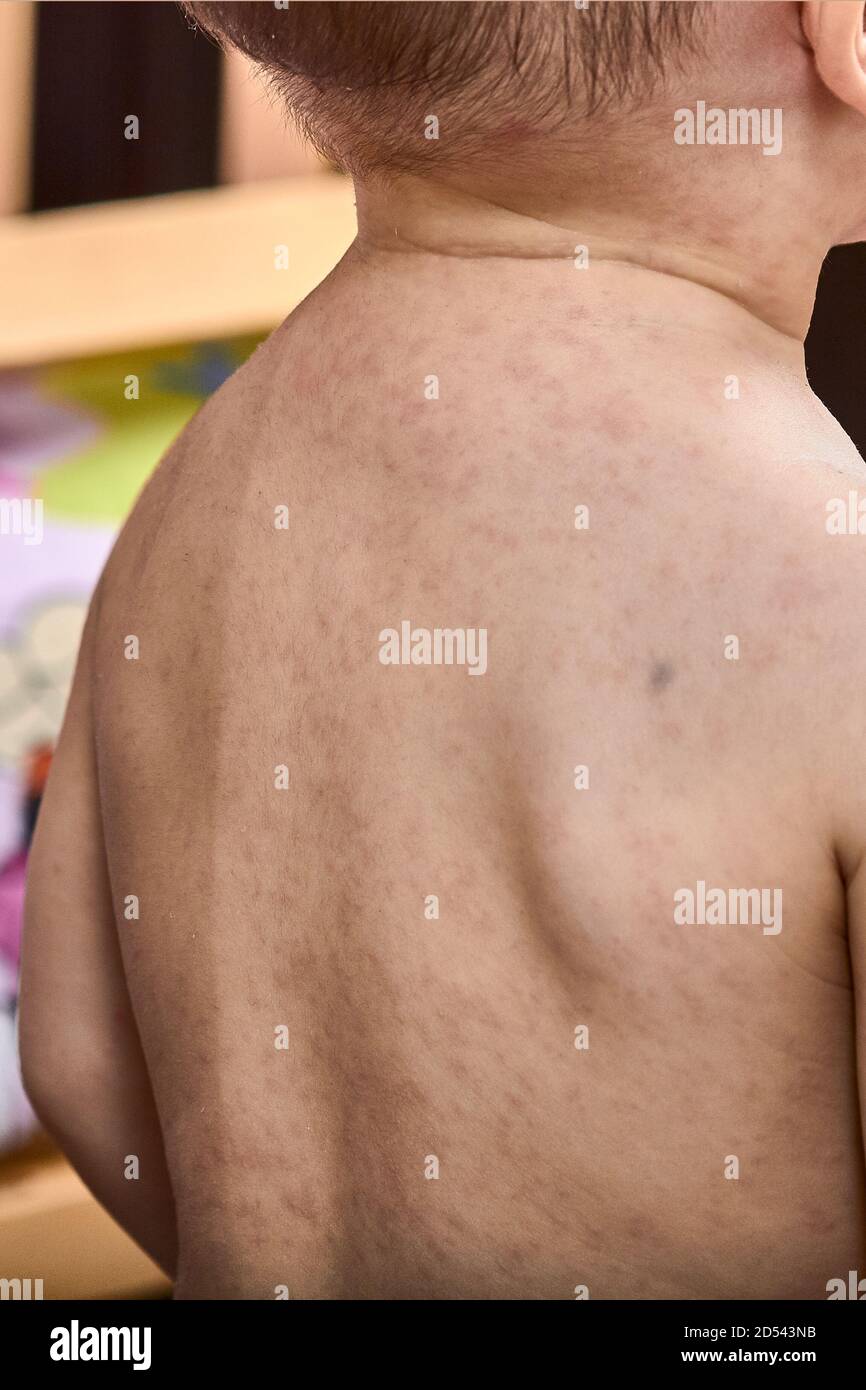 roseola rash a viral rash on the skin of a child. Stock Photo