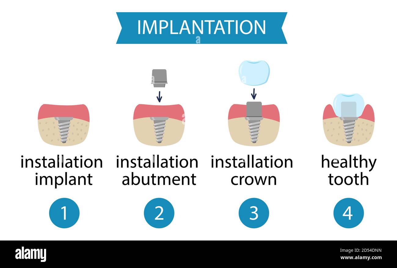 Inplant Process infographics dental implantation. Process of implant installation ...