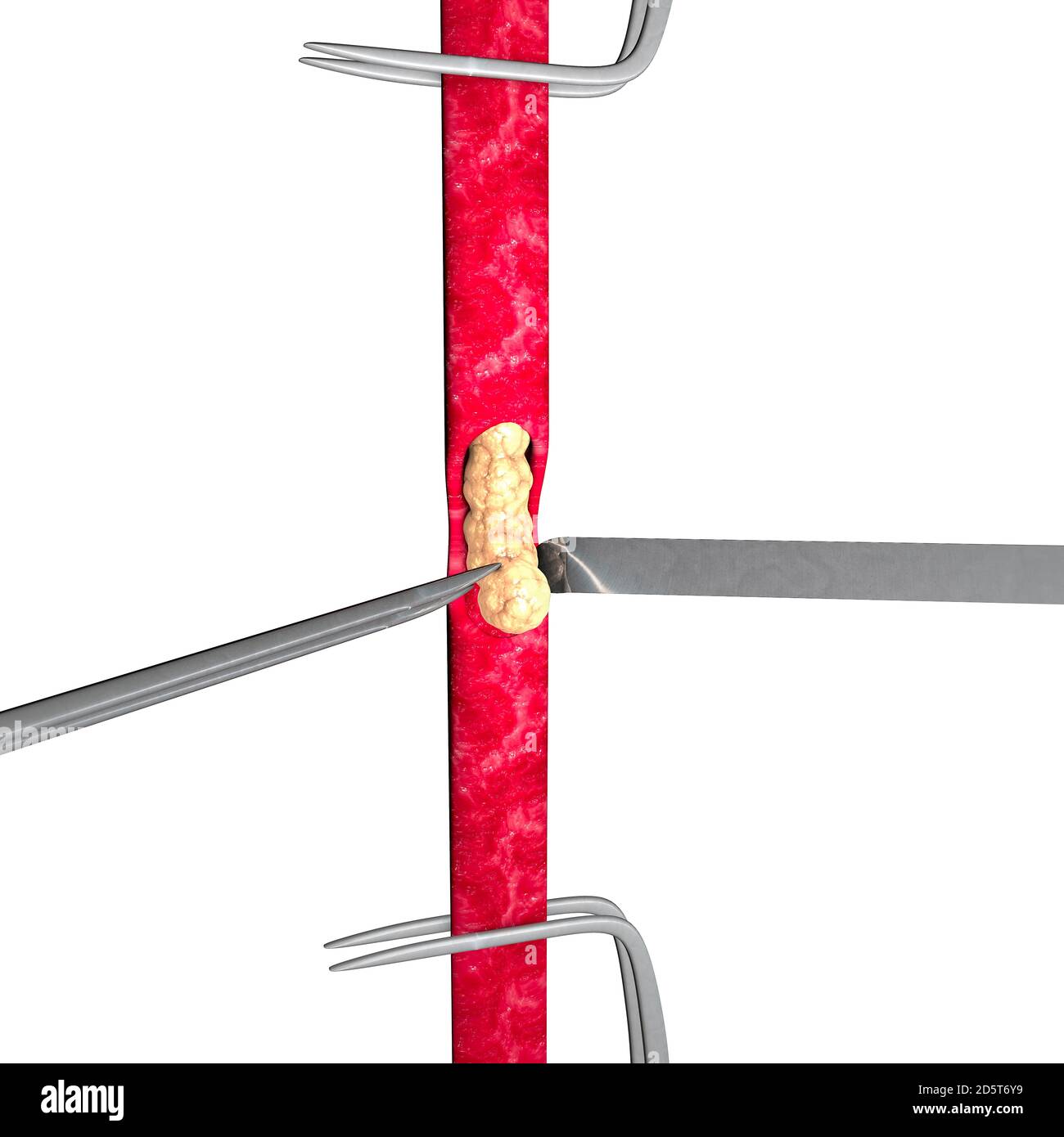 Cholesterol formation, fat, artery, vein, heart. Red blood cells, blood flow. Narrowing of a vein for fat formation. Surgery operation, 3d render Stock Photo