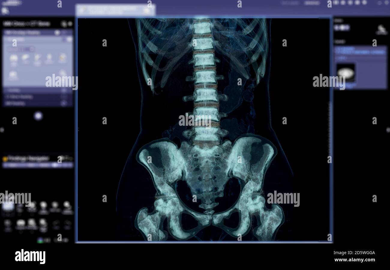 lumbar spine 3D render isolated on medical the screen Stock Photo - Alamy