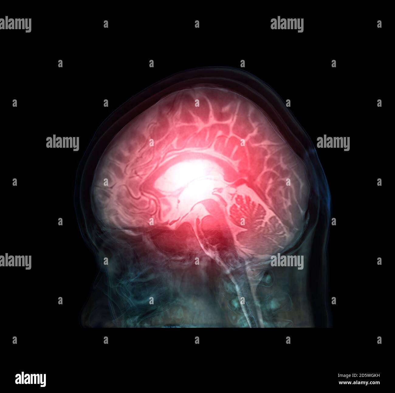 Brain Hemorrhage High Resolution Stock Photography And Images Alamy https www alamy com transparent image of the skull lateral with brain for medical background concept image382263269 html