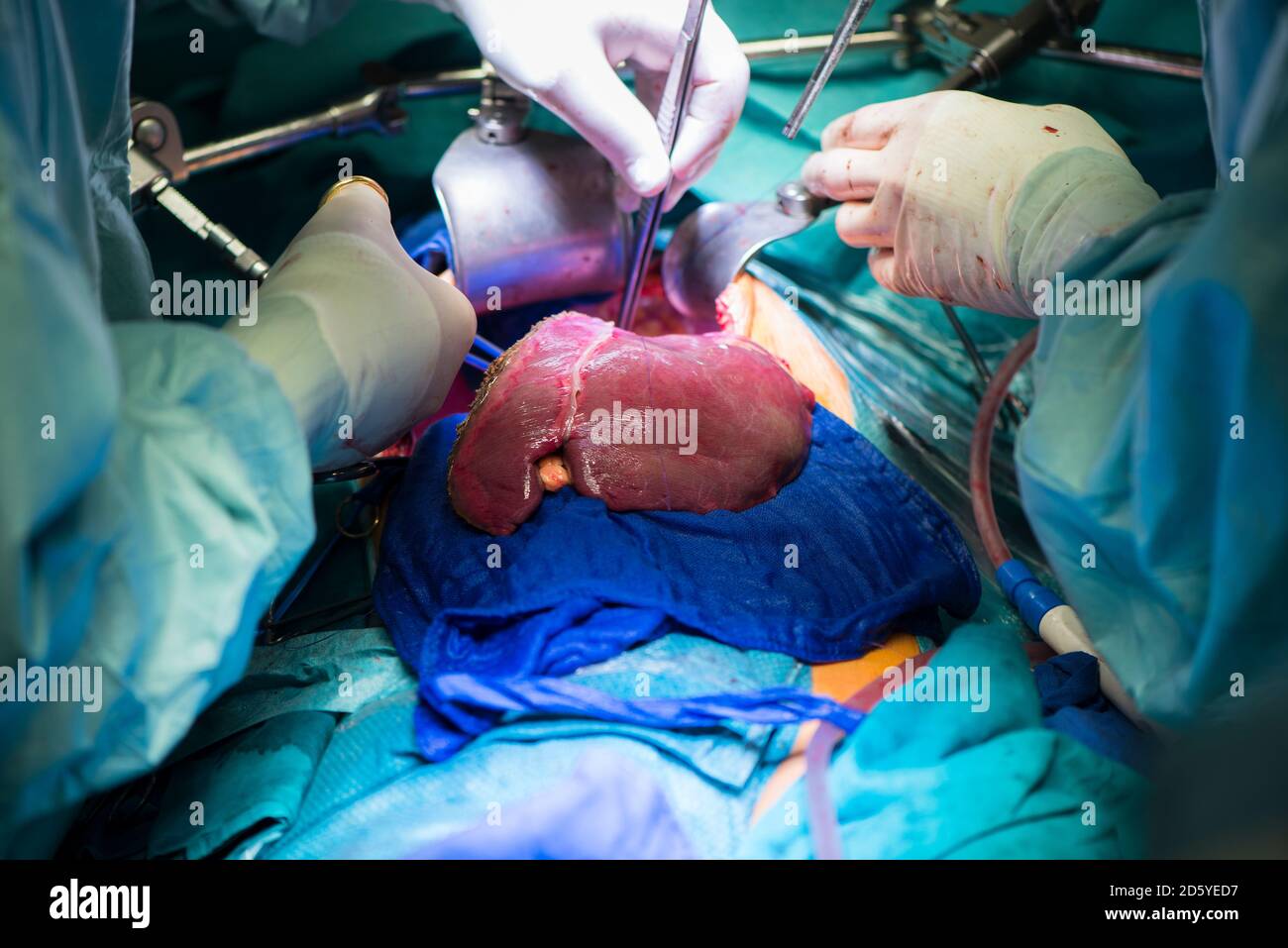 Surgeons transplanting a liver Stock Photo