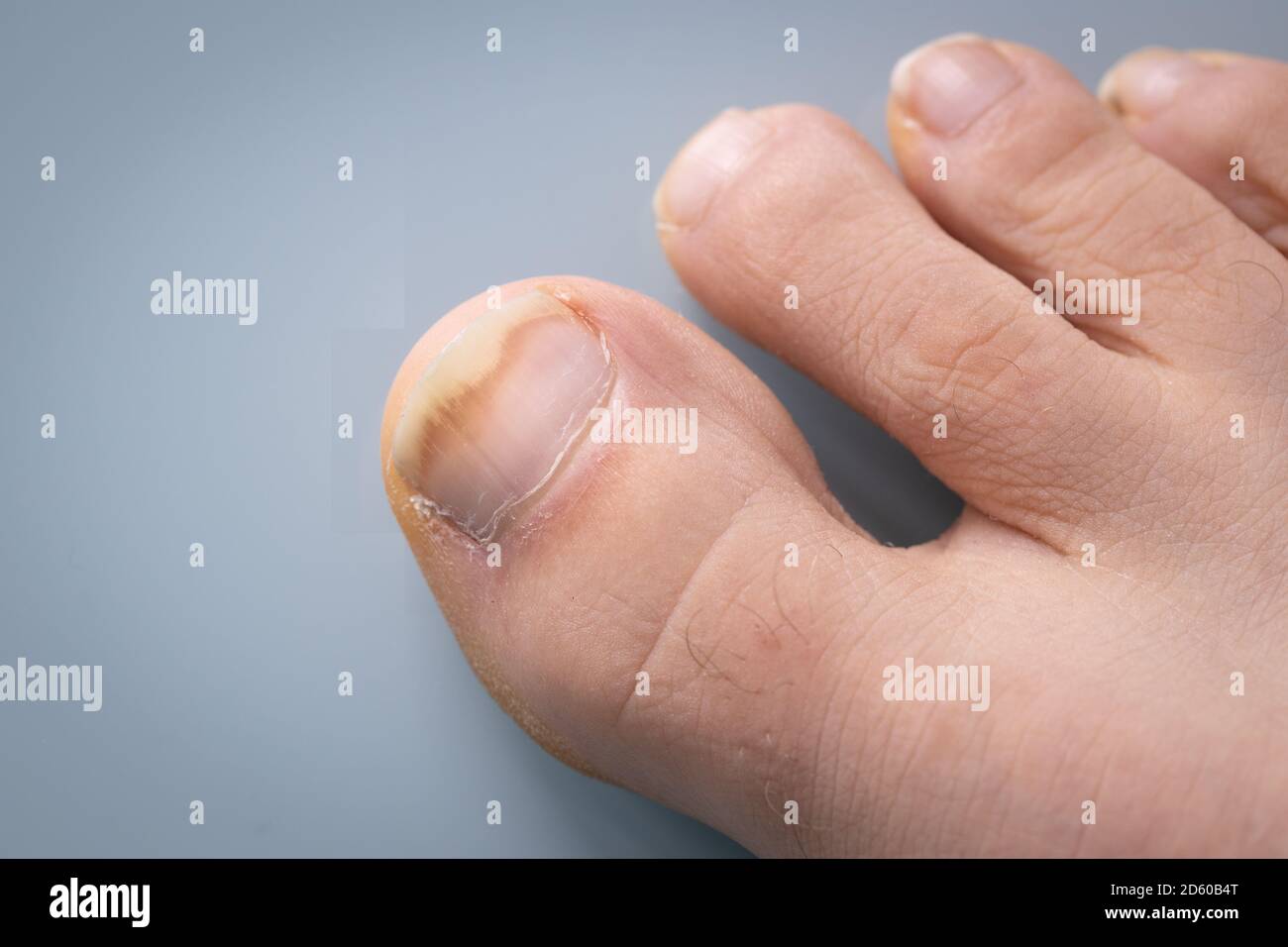 onychomycosis, The initial stage of mycosis. Big toe infected with fungal bacteria Stock Photo