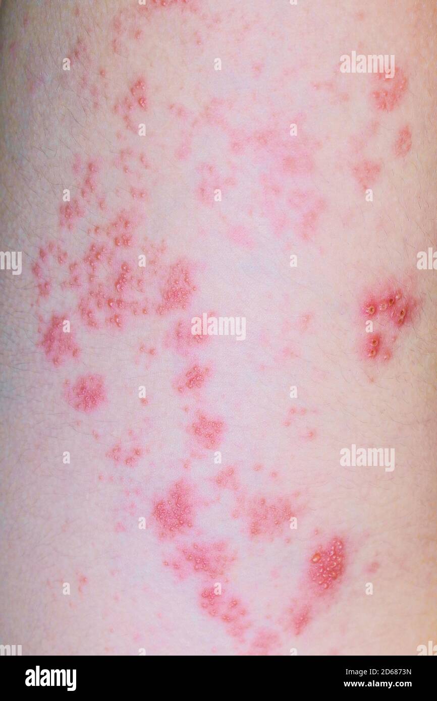 Rash with blisters in viral disease Shingles on leg of twelve years old boy Stock Photo
