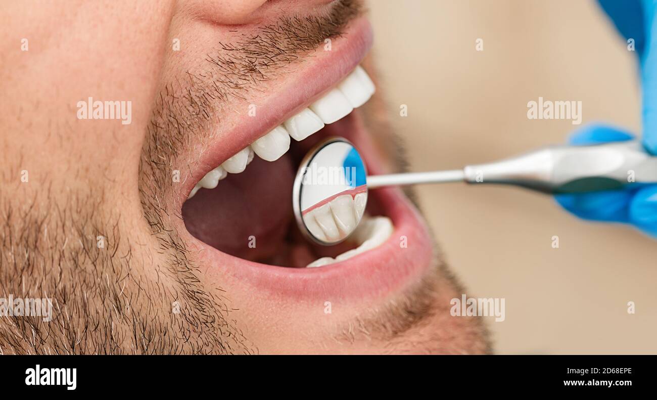 Healthy white male smile with dentist's mirror, close-up. Teeth treatment. Shot part of the head Stock Photo
