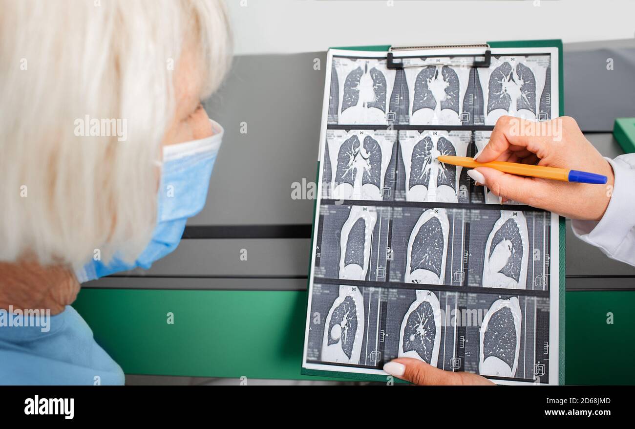 Elderly patient, CT of the lungs. Lung inflammation, bronchitis, coronavirus, COVID 19 Stock Photo